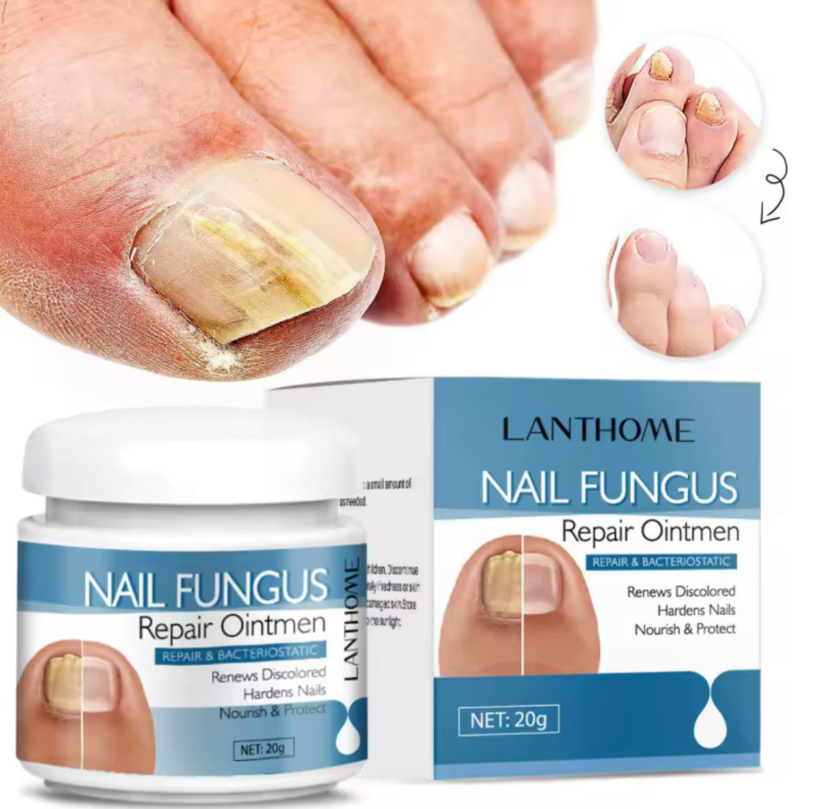 Crème Anti-Mycose Ongulaire – Résultats Rapides