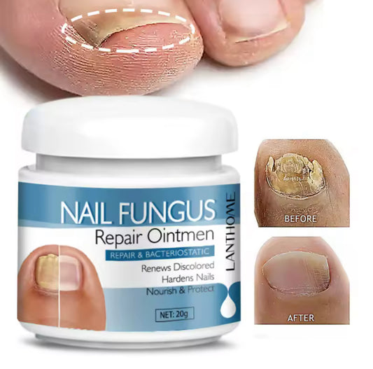 Crème Anti-Mycose Ongulaire – Résultats Rapides